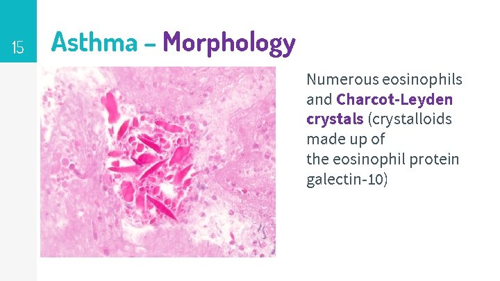 15 Asthma – Morphology Numerous eosinophils and Charcot-Leyden crystals (crystalloids made up of the