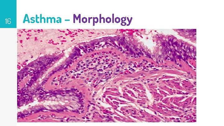 16 Asthma – Morphology 