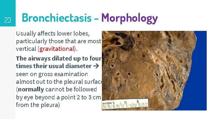23 Bronchiectasis - Morphology Usually affects lower lobes, particularly those that are most vertical