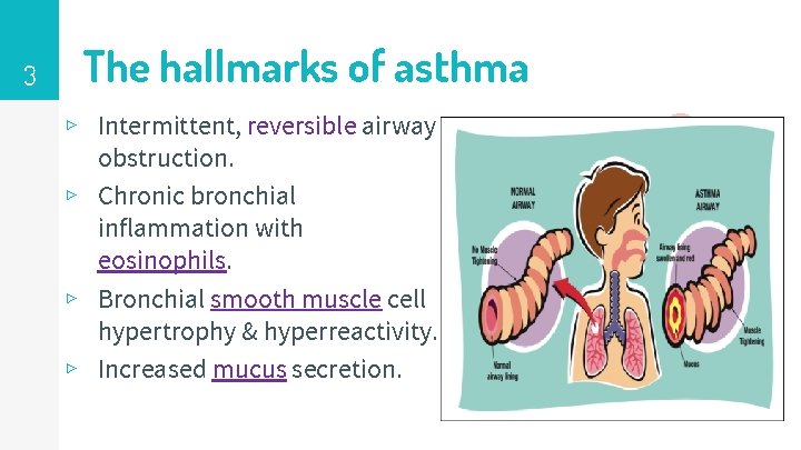3 The hallmarks of asthma ▹ Intermittent, reversible airway obstruction. ▹ Chronic bronchial inflammation