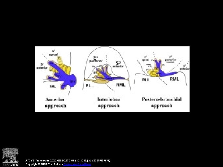 JTCVS Techniques 2020 4288 -297 DOI: (10. 1016/j. xjtc. 2020. 08. 018) Copyright ©