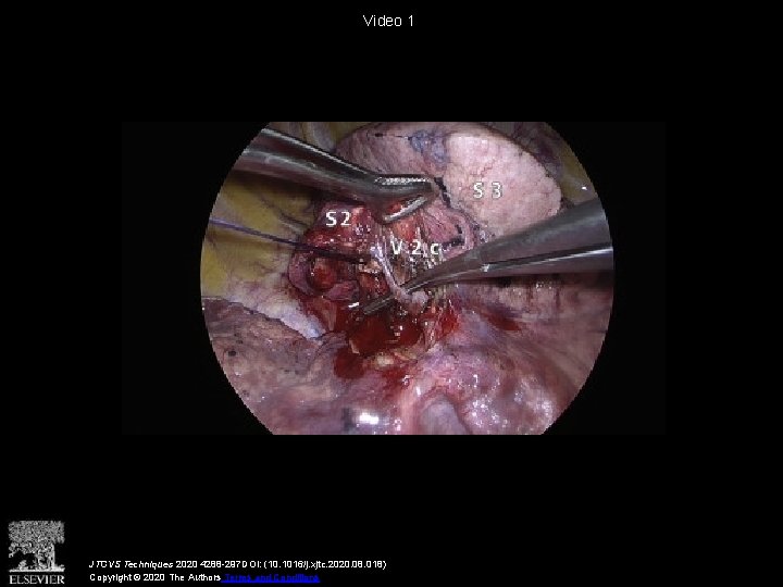 Video 1 JTCVS Techniques 2020 4288 -297 DOI: (10. 1016/j. xjtc. 2020. 08. 018)