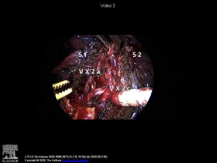 Video 2 JTCVS Techniques 2020 4288 -297 DOI: (10. 1016/j. xjtc. 2020. 08. 018)