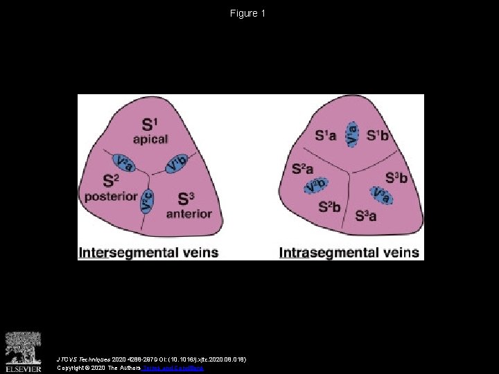 Figure 1 JTCVS Techniques 2020 4288 -297 DOI: (10. 1016/j. xjtc. 2020. 08. 018)