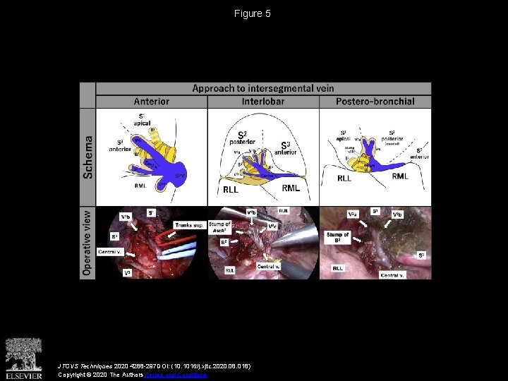 Figure 5 JTCVS Techniques 2020 4288 -297 DOI: (10. 1016/j. xjtc. 2020. 08. 018)