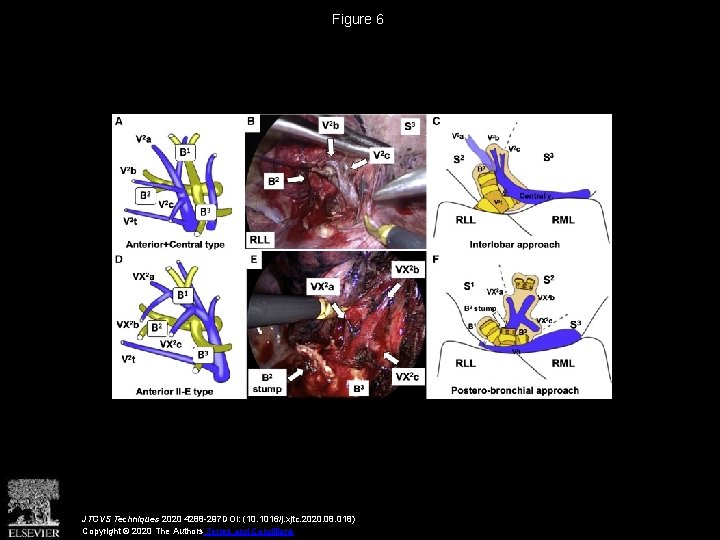 Figure 6 JTCVS Techniques 2020 4288 -297 DOI: (10. 1016/j. xjtc. 2020. 08. 018)