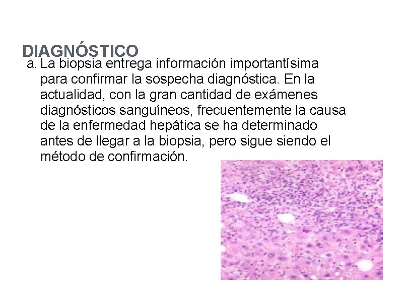 DIAGNÓSTICO a. La biopsia entrega información importantísima para confirmar la sospecha diagnóstica. En la