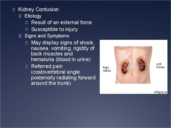 Ü Kidney Contusion Ü Etiology Ü Result of an external force Ü Susceptible to