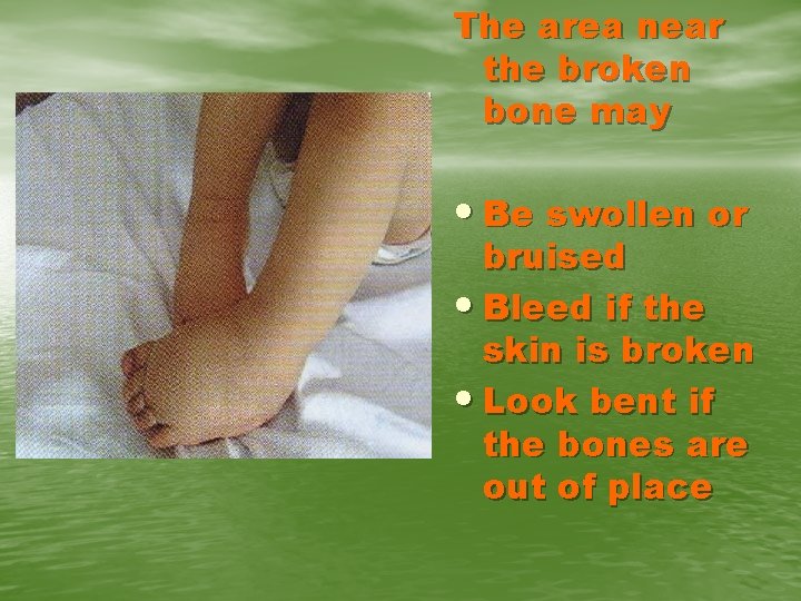 The area near the broken bone may • Be swollen or bruised • Bleed