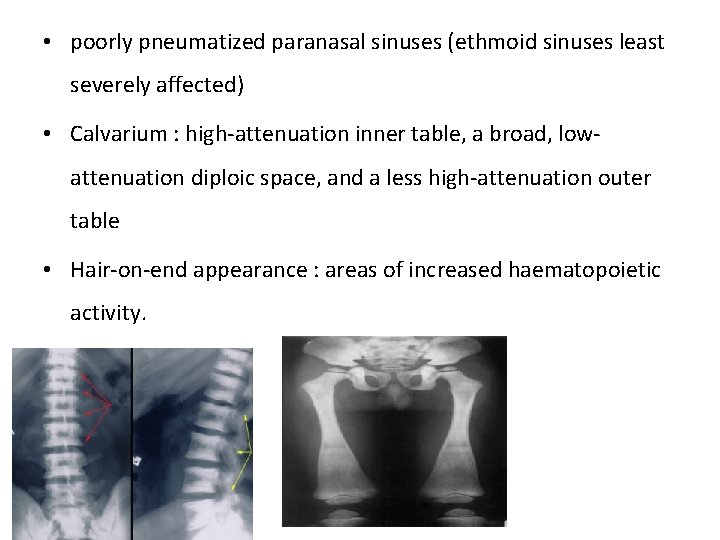  • poorly pneumatized paranasal sinuses (ethmoid sinuses least severely affected) • Calvarium :