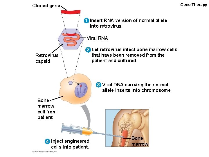 Gene Therapy Cloned gene 1 Insert RNA version of normal allele into retrovirus. Viral