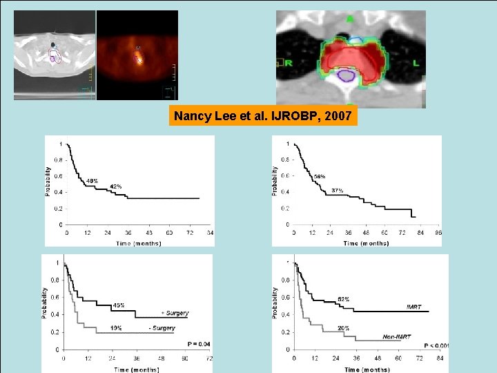 Conceptos en la re-irradiación Nancy Lee et al. IJROBP, 2007 Ø Planificación con PET-TAC.