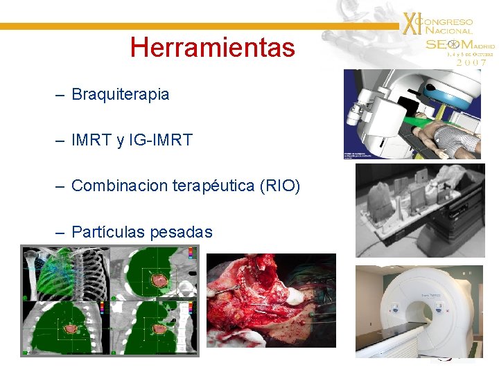 Herramientas – Braquiterapia – IMRT y IG-IMRT – Combinacion terapéutica (RIO) – Partículas pesadas