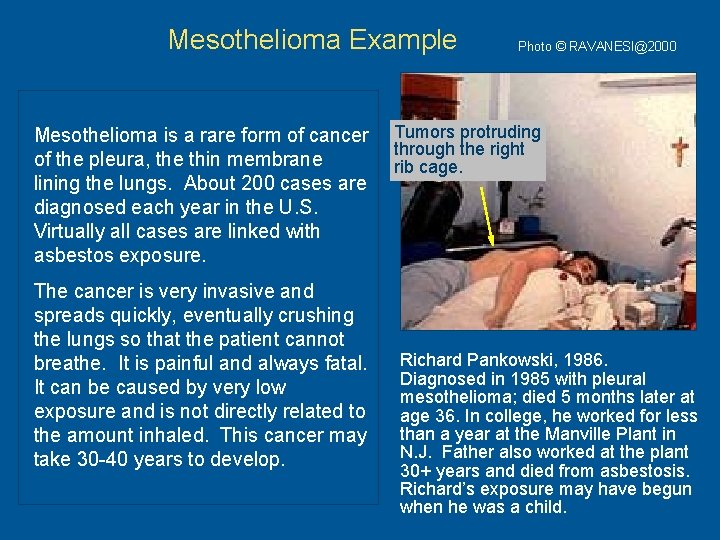 Mesothelioma Example Mesothelioma is a rare form of cancer of the pleura, the thin