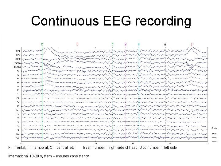 Continuous EEG recording F = frontal, T = temporal, C = central, etc Even