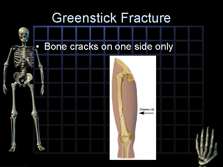 Greenstick Fracture • Bone cracks on one side only 