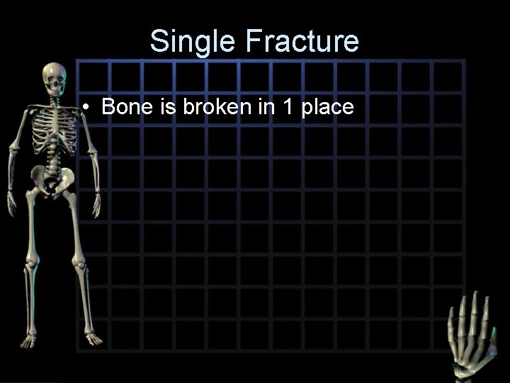 Single Fracture • Bone is broken in 1 place 