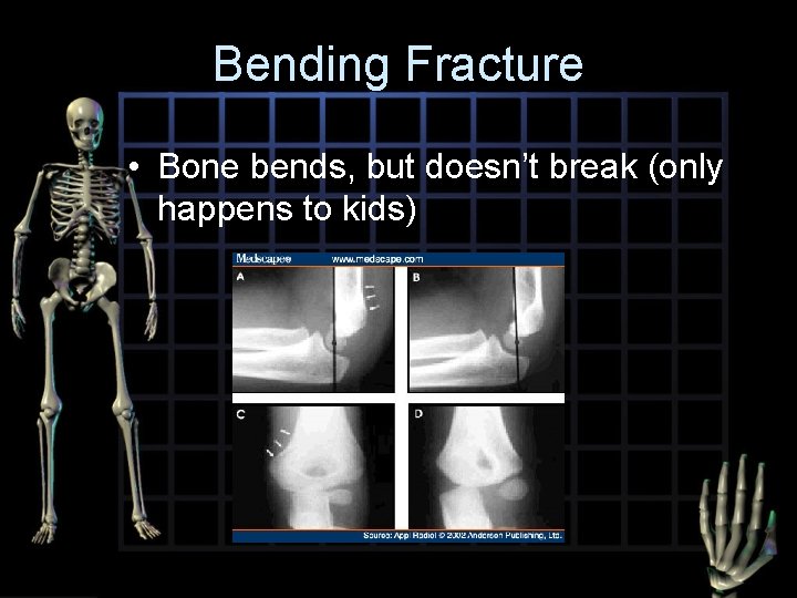 Bending Fracture • Bone bends, but doesn’t break (only happens to kids) 