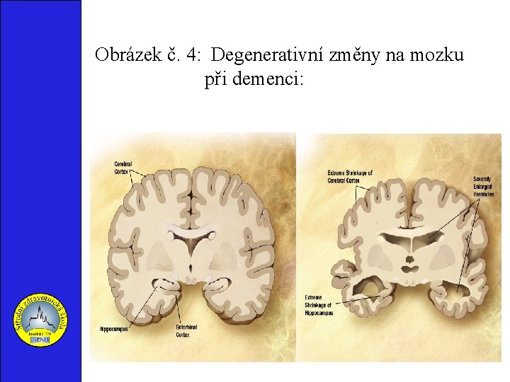 Obrázek č. 4: Degenerativní změny na mozku při demenci: 