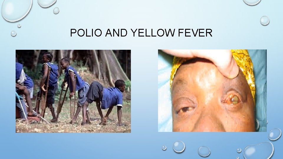 POLIO AND YELLOW FEVER 