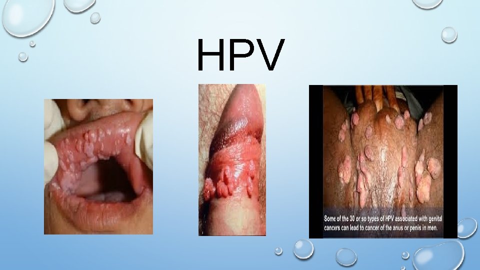 HPV 