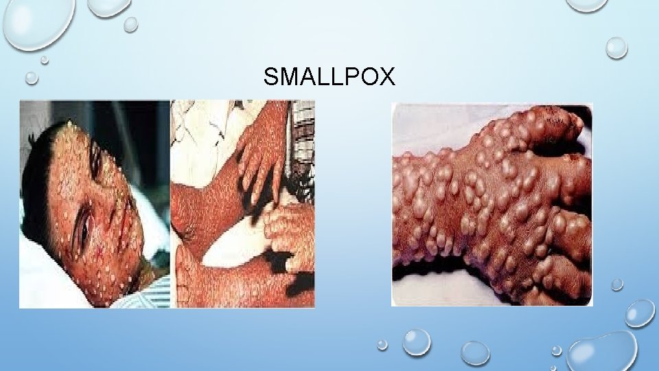 SMALLPOX 