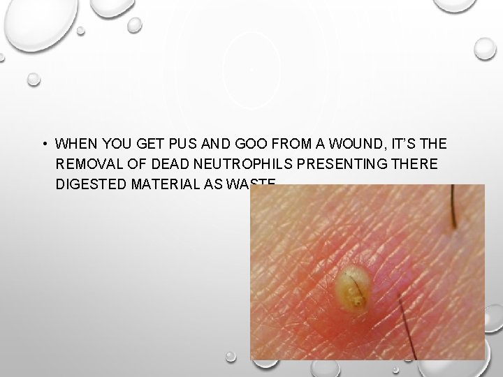  • WHEN YOU GET PUS AND GOO FROM A WOUND, IT’S THE REMOVAL