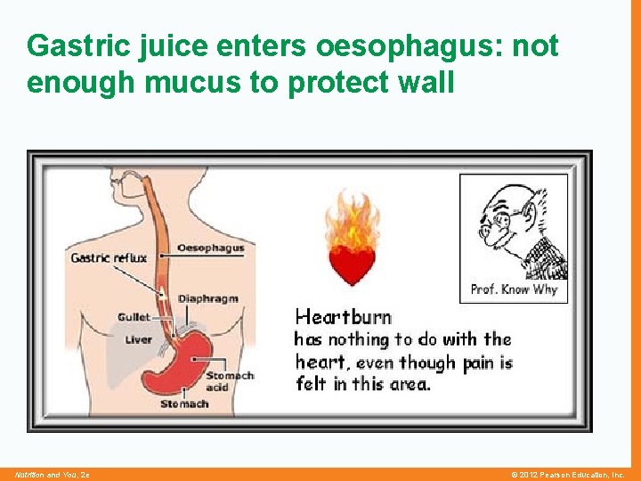 Gastric juice enters oesophagus: not enough mucus to protect wall Nutrition and You, 2
