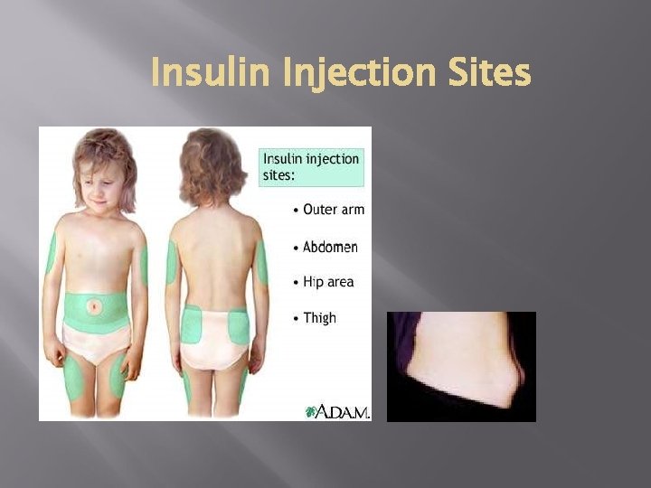Insulin Injection Sites Picture of lipohypertrophy 