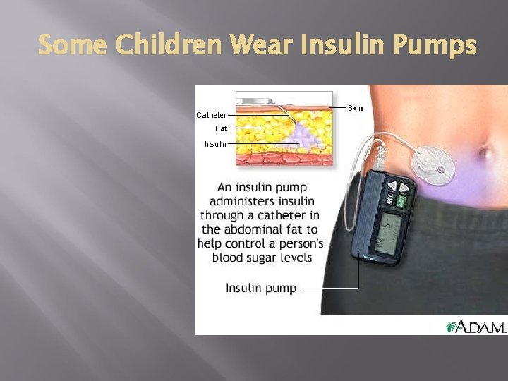 Some Children Wear Insulin Pumps 