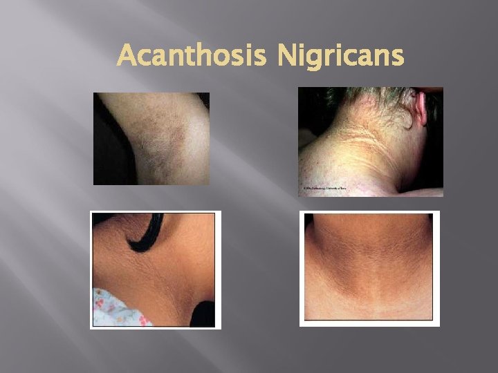 Acanthosis Nigricans 