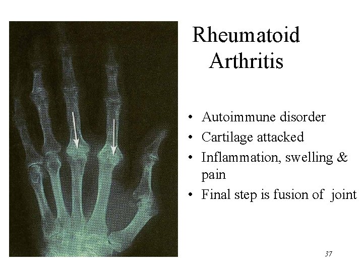 Rheumatoid Arthritis • Autoimmune disorder • Cartilage attacked • Inflammation, swelling & pain •