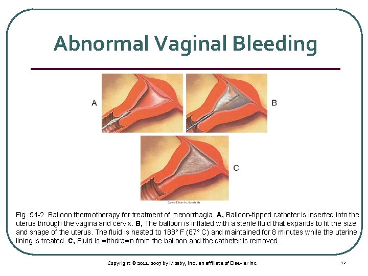 Abnormal Vaginal Bleeding Fig. 54 2. Balloon thermotherapy for treatment of menorrhagia. A, Balloon
