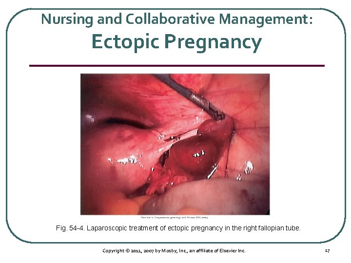 Nursing and Collaborative Management: Ectopic Pregnancy Fig. 54 4. Laparoscopic treatment of ectopic pregnancy