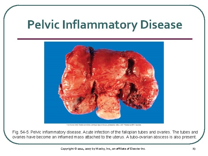 Pelvic Inflammatory Disease Fig. 54 5. Pelvic inflammatory disease. Acute infection of the fallopian
