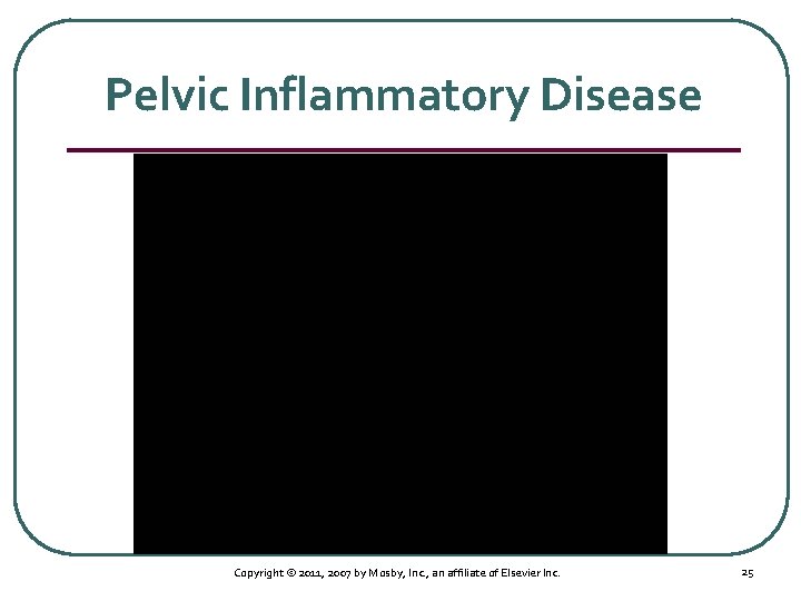 Pelvic Inflammatory Disease Copyright © 2011, 2007 by Mosby, Inc. , an affiliate of
