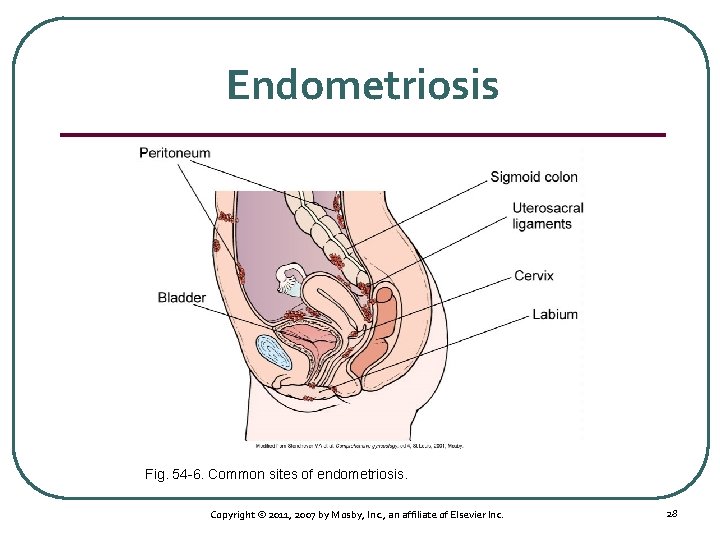 Endometriosis Fig. 54 6. Common sites of endometriosis. Copyright © 2011, 2007 by Mosby,