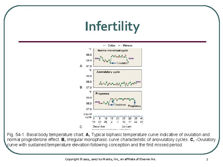 Infertility Fig. 54 1. Basal body temperature chart. A, Typical biphasic temperature curve indicative