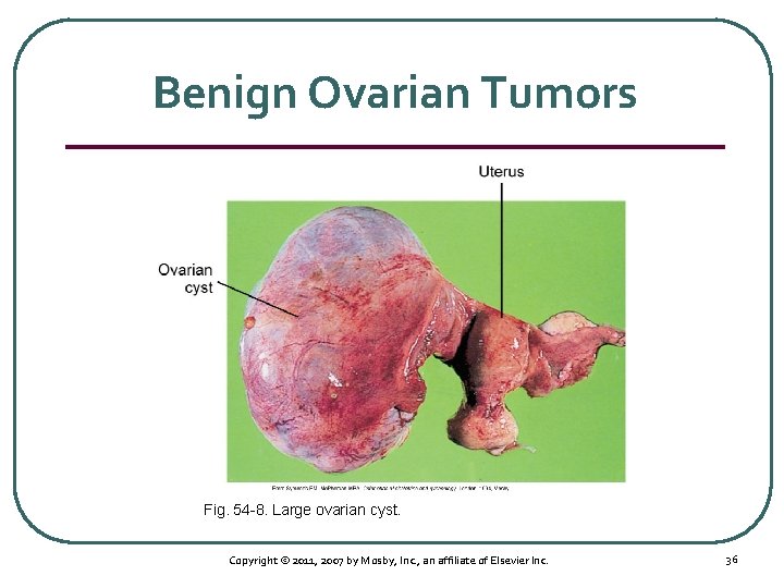 Benign Ovarian Tumors Fig. 54 8. Large ovarian cyst. Copyright © 2011, 2007 by
