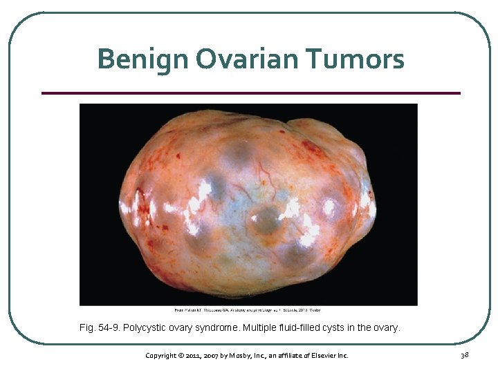 Benign Ovarian Tumors Fig. 54 9. Polycystic ovary syndrome. Multiple fluid filled cysts in