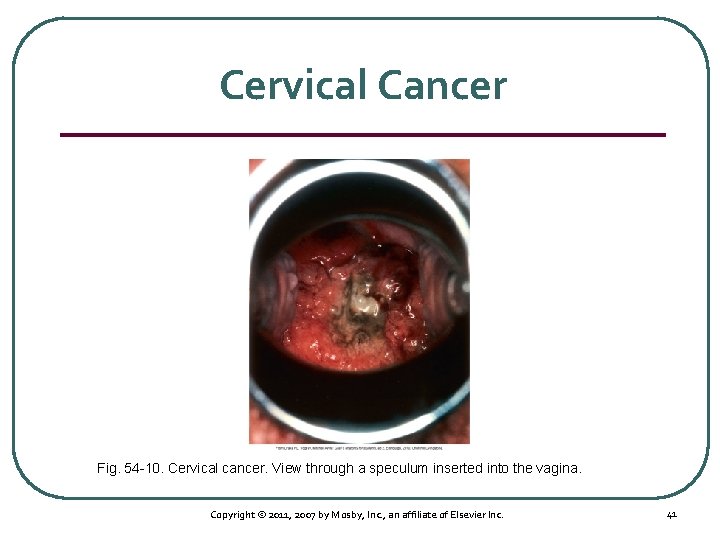 Cervical Cancer Fig. 54 10. Cervical cancer. View through a speculum inserted into the
