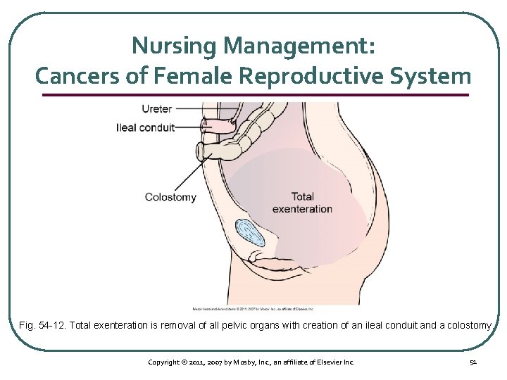 Nursing Management: Cancers of Female Reproductive System Fig. 54 12. Total exenteration is removal
