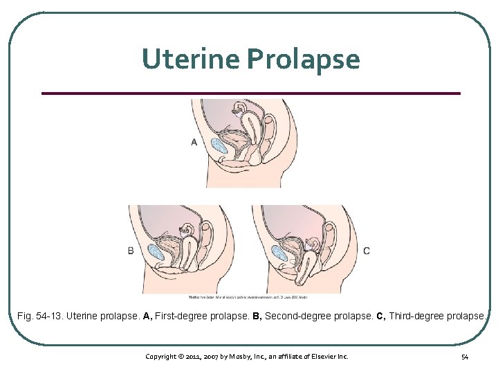 Uterine Prolapse Fig. 54 13. Uterine prolapse. A, First degree prolapse. B, Second degree