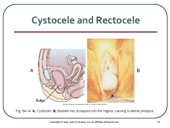 Cystocele and Rectocele Fig. 54 14. A, Cystocele. B, Bladder has prolapsed into the