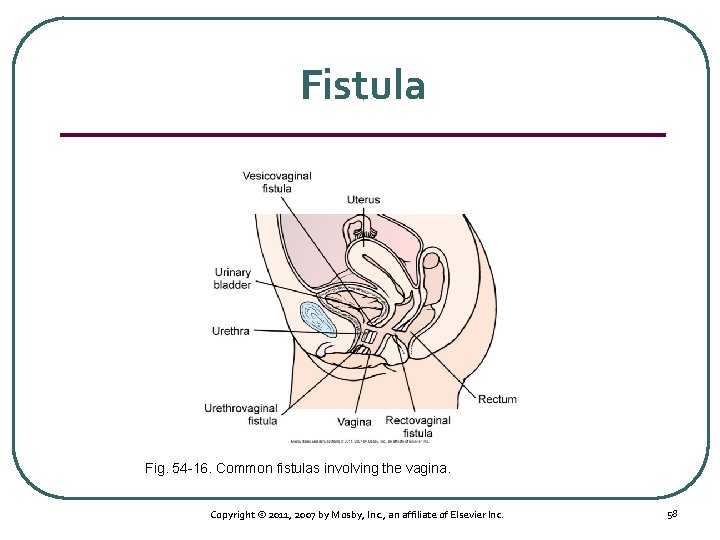 Fistula Fig. 54 16. Common fistulas involving the vagina. Copyright © 2011, 2007 by