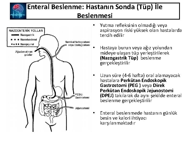 Enteral Beslenme: Hastanın Sonda (Tüp) İle Beslenmesi • Yutma refleksinin olmadığı veya aspirasyon riski
