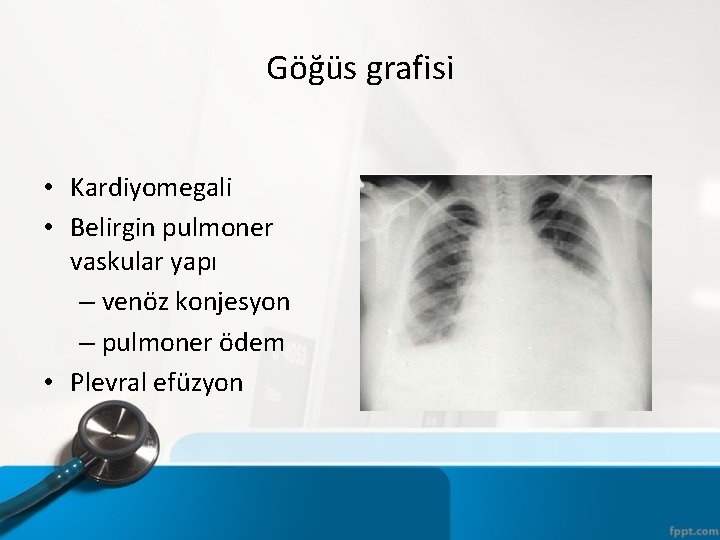 Göğüs grafisi • Kardiyomegali • Belirgin pulmoner vaskular yapı – venöz konjesyon – pulmoner