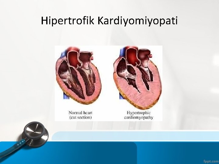 Hipertrofik Kardiyomiyopati 