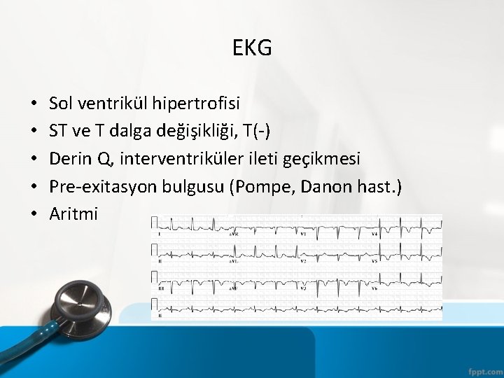 EKG • • • Sol ventrikül hipertrofisi ST ve T dalga değişikliği, T(-) Derin