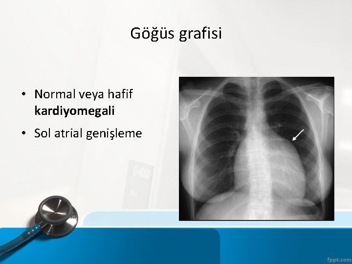 Göğüs grafisi • Normal veya hafif kardiyomegali • Sol atrial genişleme 